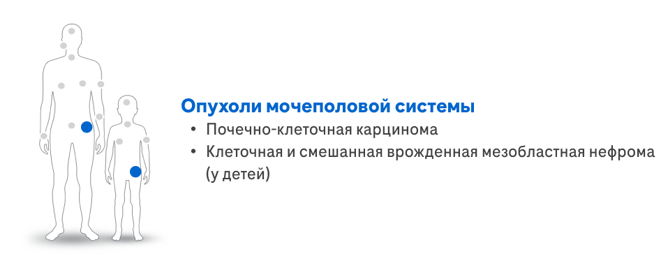 Опухоли мочеполовой системы