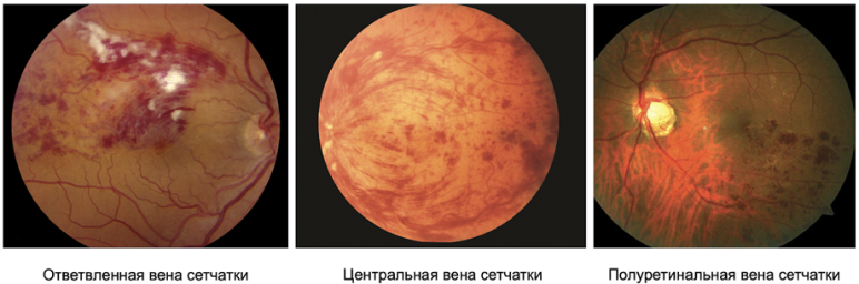 Рисунок 1. Основные типы окклюзии вен сетчатки